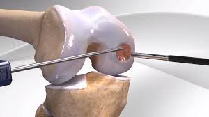 restaurarea articulațiilor cartilajelor
